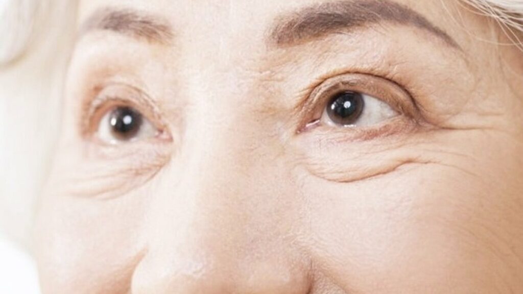 눈 건조증이 심한 노인 눈가 클로즈업 이미지, 라식 수술 부적합 사례