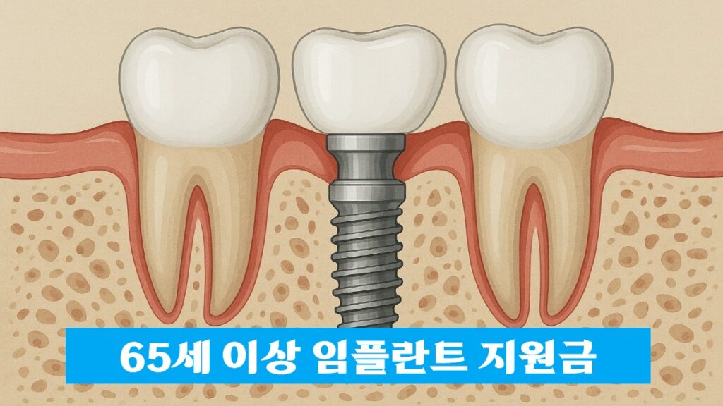 65세 이상 임플란트 구조 및 지원금 적용 예시 이미지